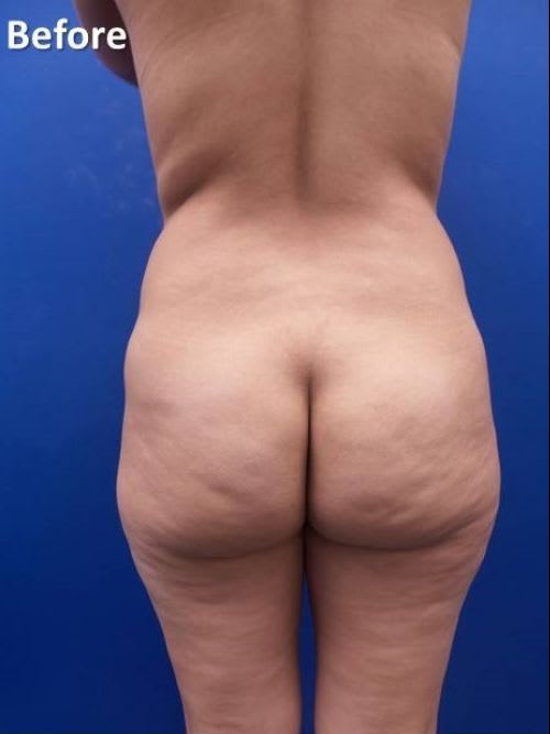 Brazilian Butt Lift Before, undefined undefined - 1984
