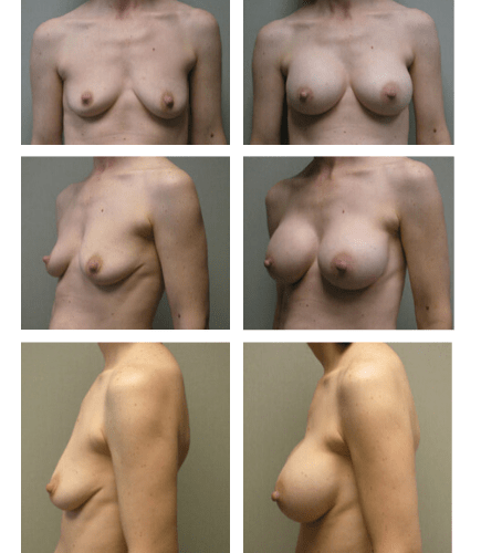 Breast Augmentation with Implants After, undefined undefined - 3211
