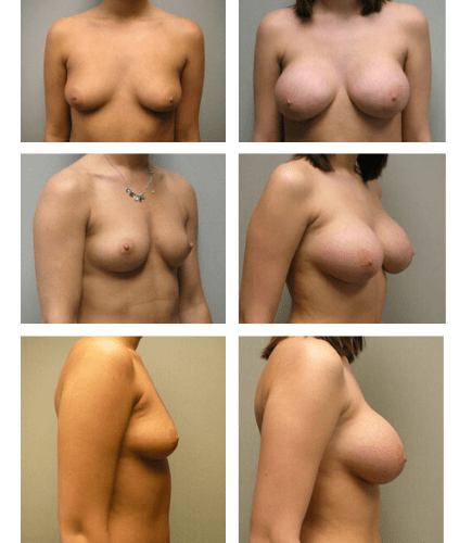 Breast Augmentation with Implants Before, undefined undefined - 3211