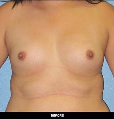 Breast Augmentation (Augmentation Mammaplasty) Before, undefined undefined - 2449