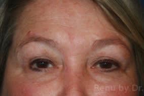 Brow Lift Before, undefined undefined - 2645