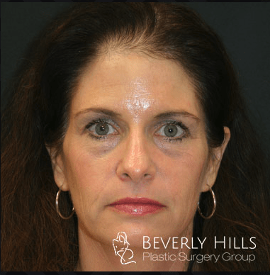 Brow Lift Before, undefined undefined - 408