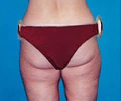 Butt Lift Before, undefined undefined - 1080