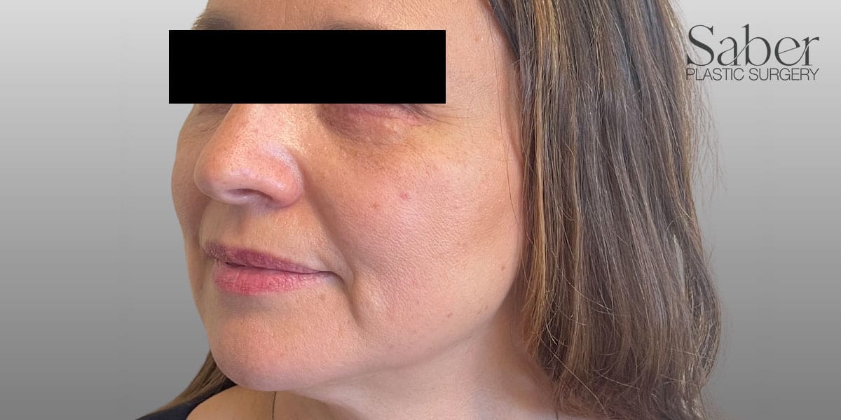 Blepharoplasty After, undefined undefined - 3918