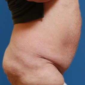 Panniculectomy After, undefined undefined - 2894