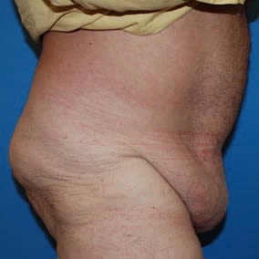 Panniculectomy Before, undefined undefined - 2894