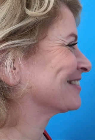 Rhinoplasty Before, undefined undefined - 2095