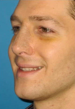 Nose Bump Solutions After, undefined undefined - 2096