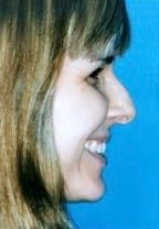 Nose Angle Solutions Before, undefined undefined - 2098