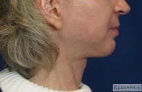 Facelift After, undefined undefined - 2754