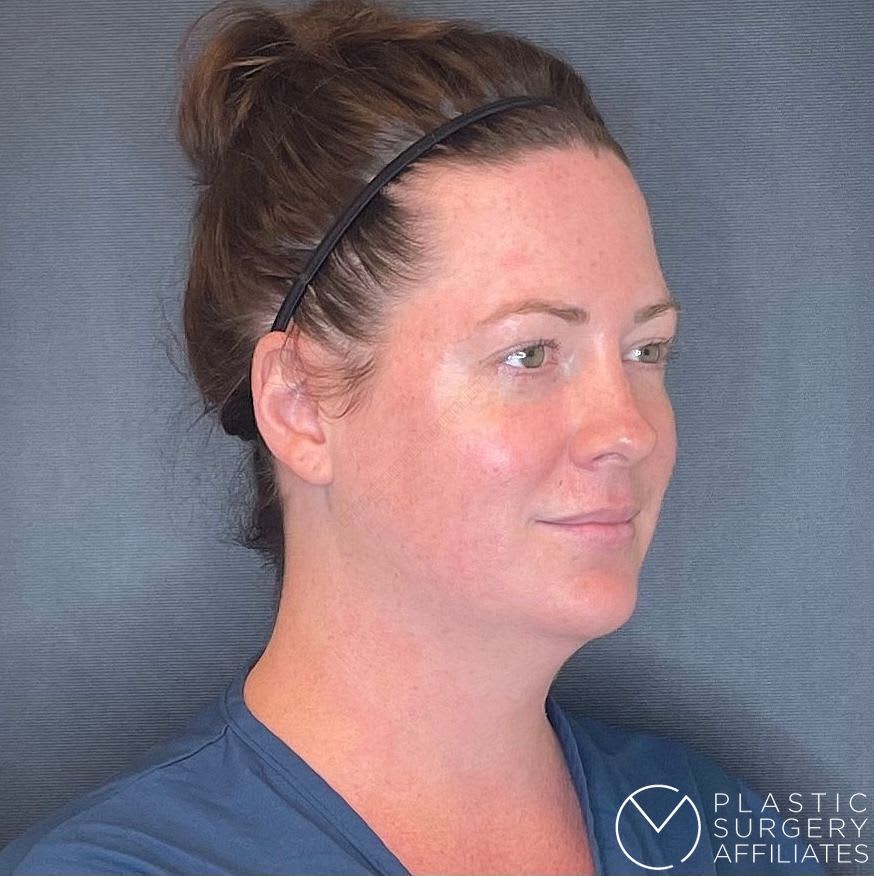 Awake Neck Lift Before, undefined undefined - 2279