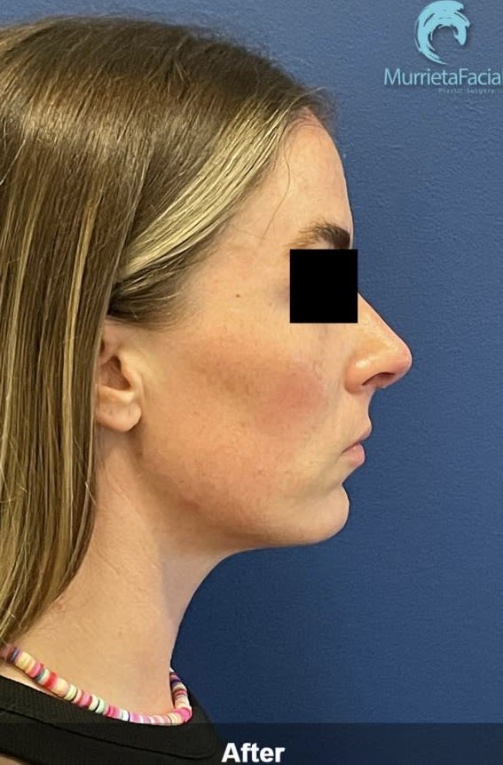 Rhinoplasty After, undefined undefined - 3547
