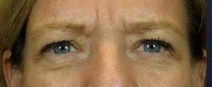Blepharoplasty Before, undefined undefined - 2788