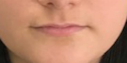 Dermal Fillers & Injectables Before, undefined undefined - 2633
