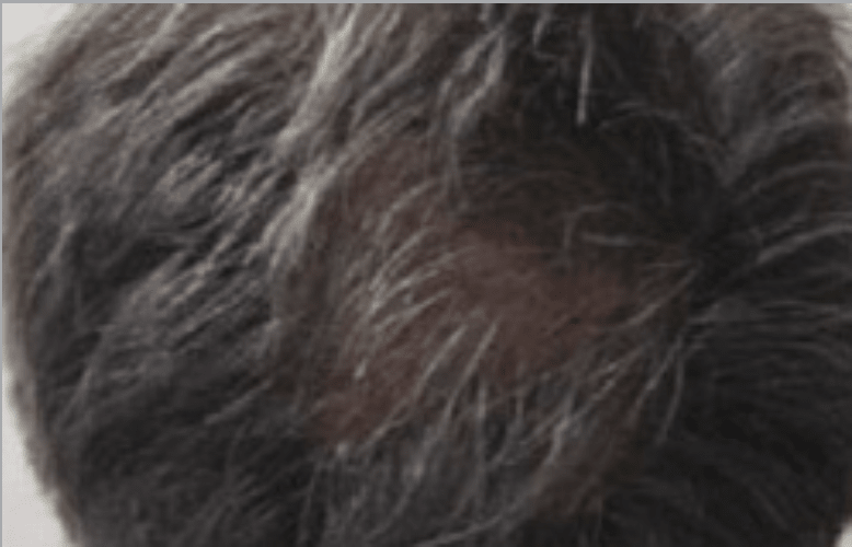 Hair Restoration After, undefined undefined - 3035