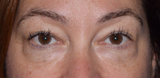Blepharoplasty Before, undefined undefined - 2969