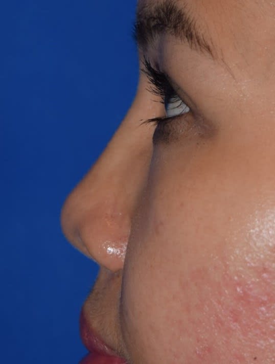 Radiesse® After, undefined undefined - 3009