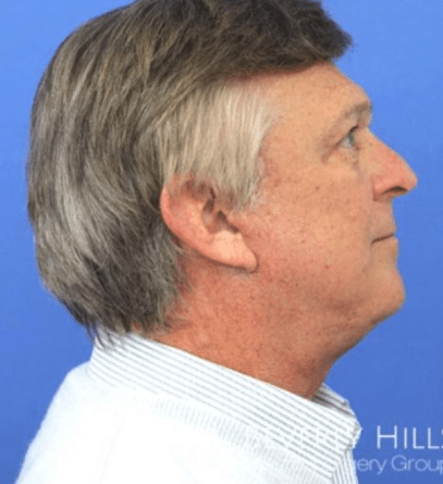 Neck Lift After, undefined undefined - 2933
