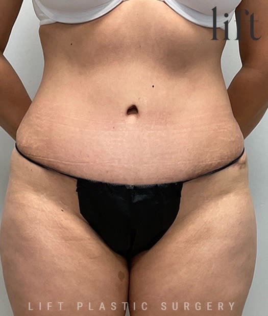 Abdominoplasty After, undefined undefined - 2861