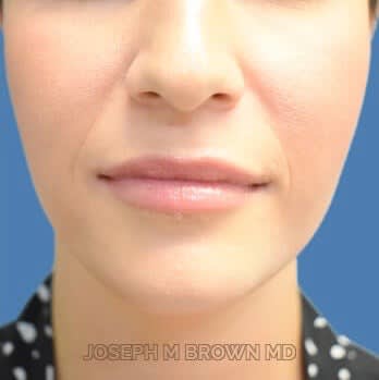 Juvéderm® After, undefined undefined - 2172