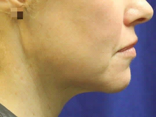 Liposuction After, undefined undefined - 2877