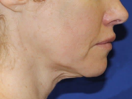 Liposuction Before, undefined undefined - 2877