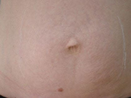 Stretch Mark Solutions After, undefined undefined - 2881
