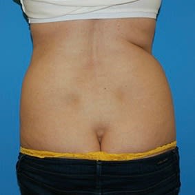 Tummy Tuck (Abdominoplasty) Before, undefined undefined - 2907