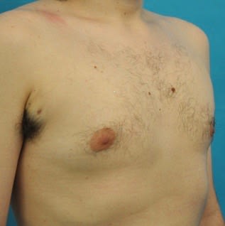Male Breast Reduction (Gynecomastia Surgery) After, undefined undefined - 2167