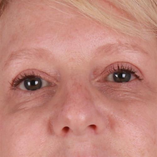 Blepharoplasty After, undefined undefined - 2131