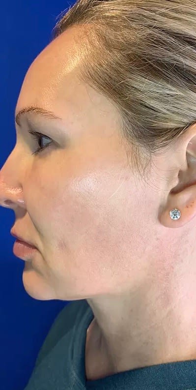 Dermal Fillers & Injectables Before, undefined undefined - 2842