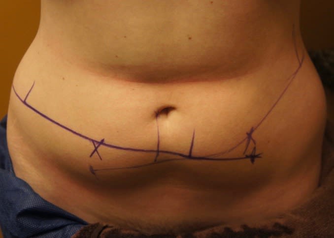 CoolSculpting® Before, undefined undefined - 1983