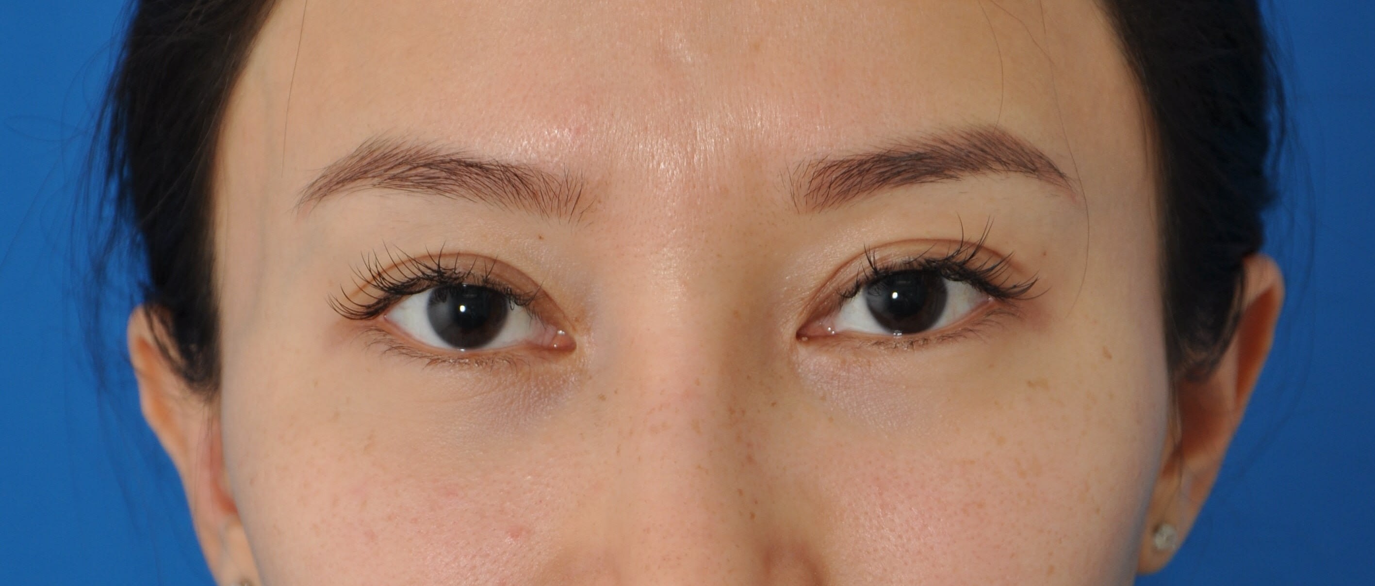 Asian Blepharoplasty After, undefined undefined - 1379