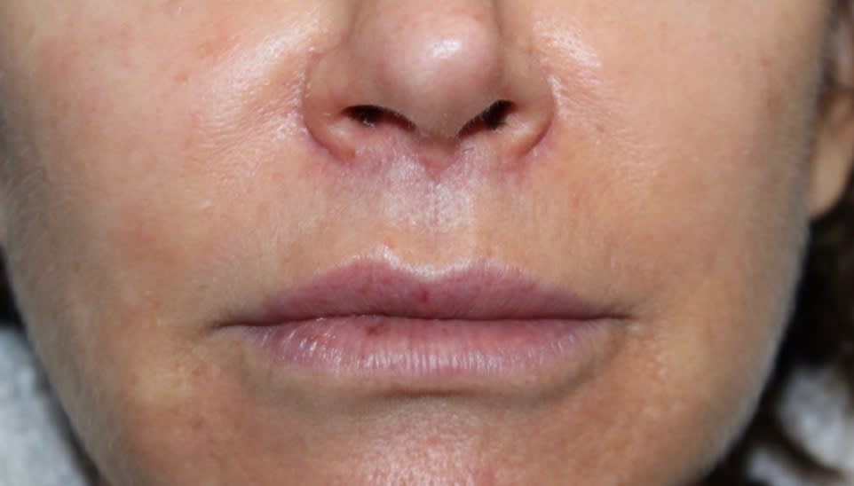 Lip Lift After, undefined undefined - 1717