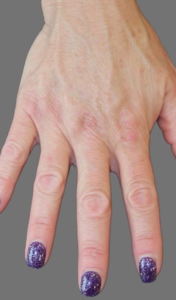Dermal Fillers & Injectables After, undefined undefined - 1718
