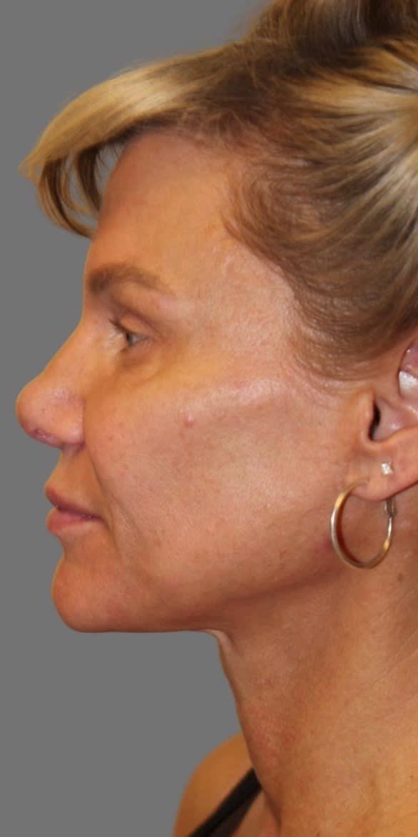 Deep Plane Facelift Before, undefined undefined - 1719