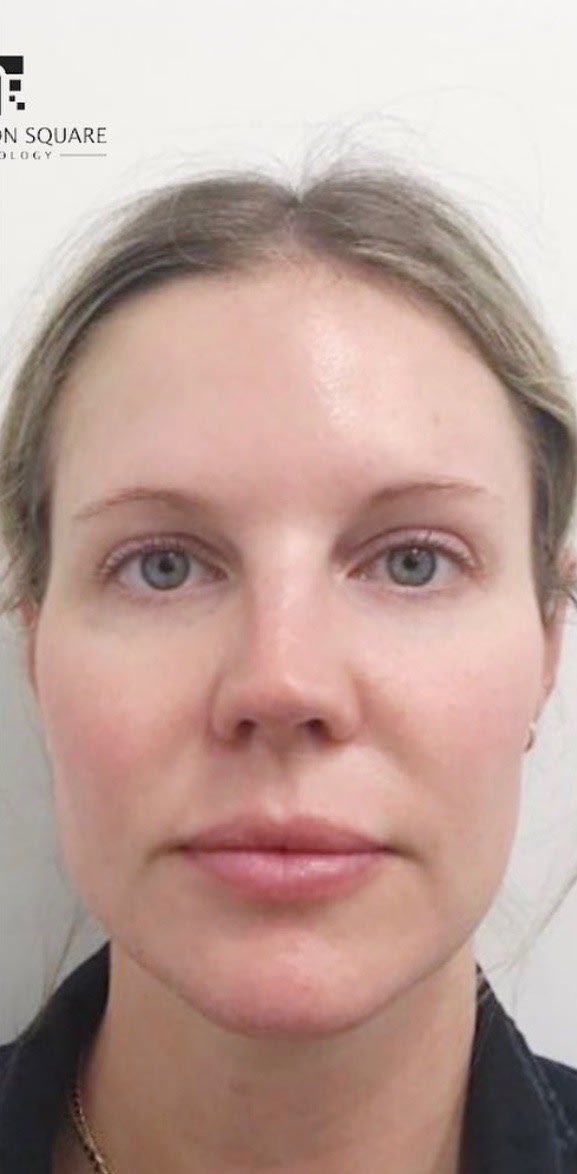 Dermal Fillers & Injectables After, undefined undefined - 3124