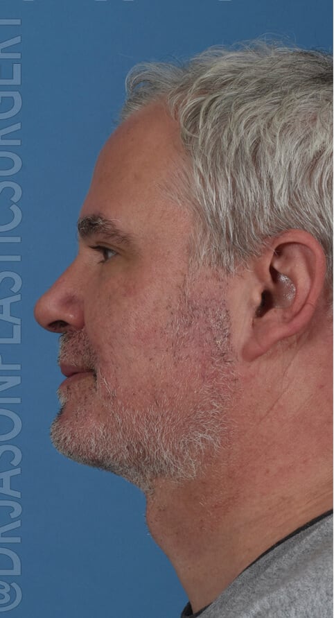Neck Lift After, undefined undefined - 401