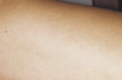 Vein Solutions After, undefined undefined - 4844