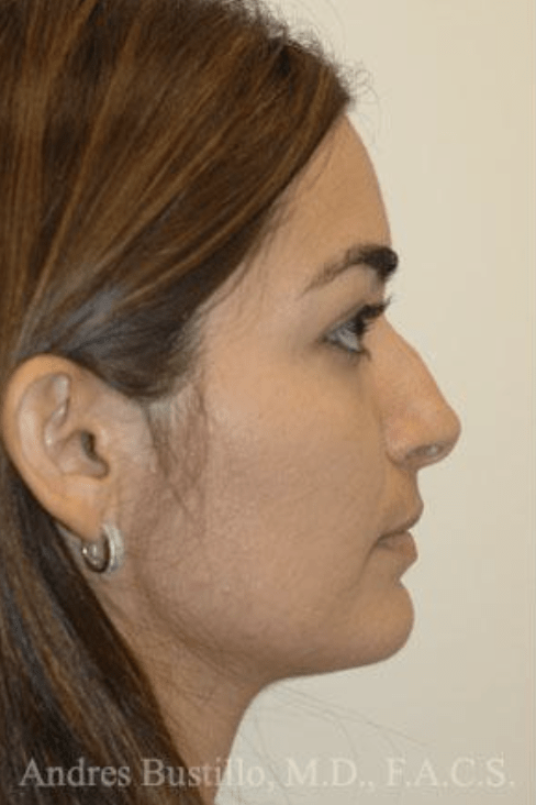 Rhinoplasty Before, undefined undefined - 4753
