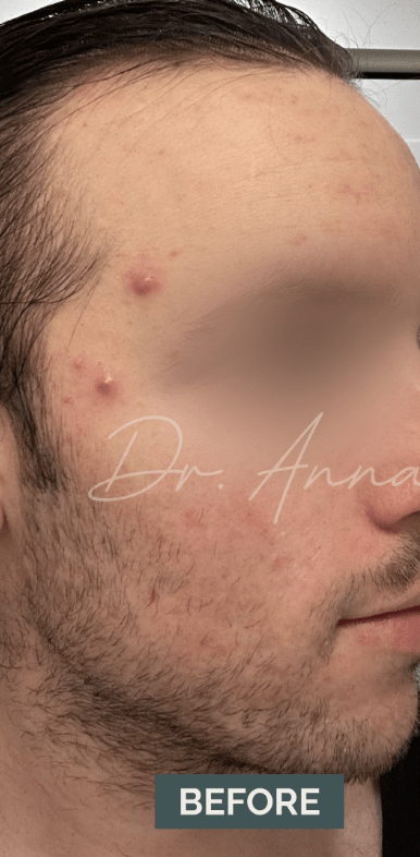 Acne Treatment Before, undefined undefined - 4829