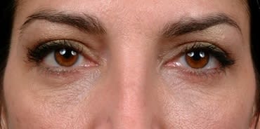 Blepharoplasty After, undefined undefined - 4689