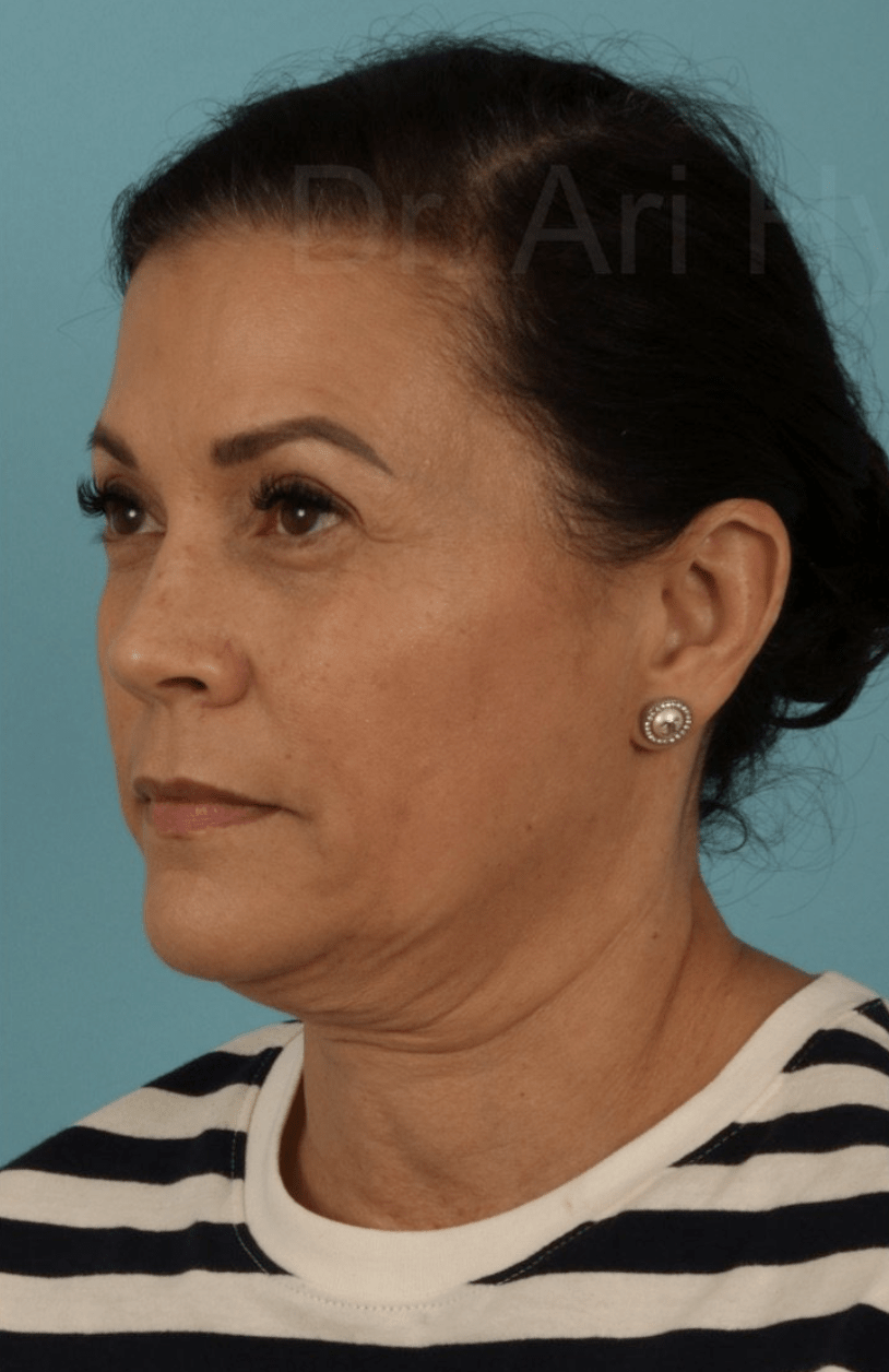 Neck Lift Before, undefined undefined - 4835