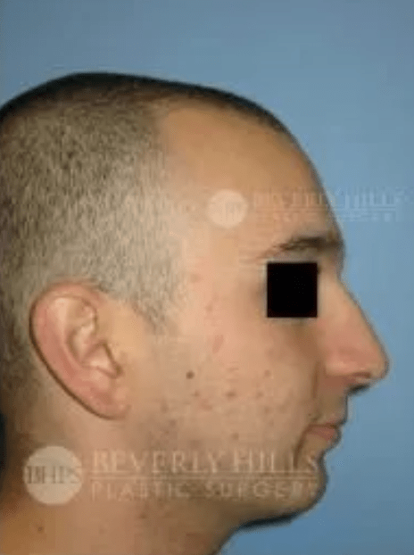 Rhinoplasty Before, undefined undefined - 4821