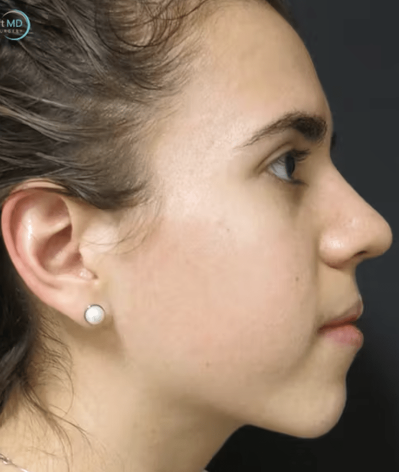 Rhinoplasty After, undefined undefined - 4709