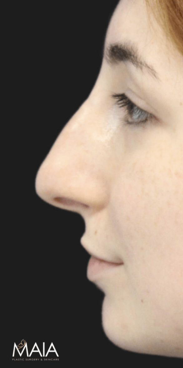 Rhinoplasty Before, undefined undefined - 4734