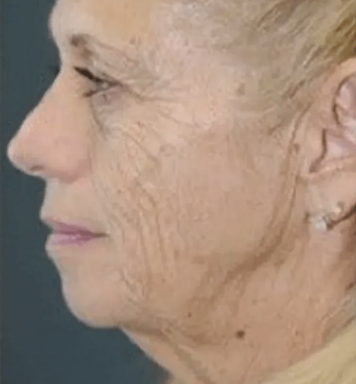 Facelift Before, undefined undefined - 4850