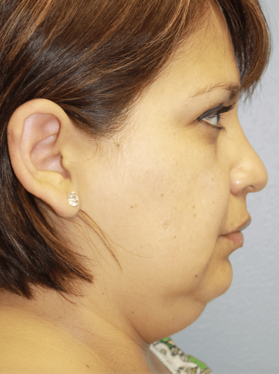 Neck Lift Before, undefined undefined - 4633