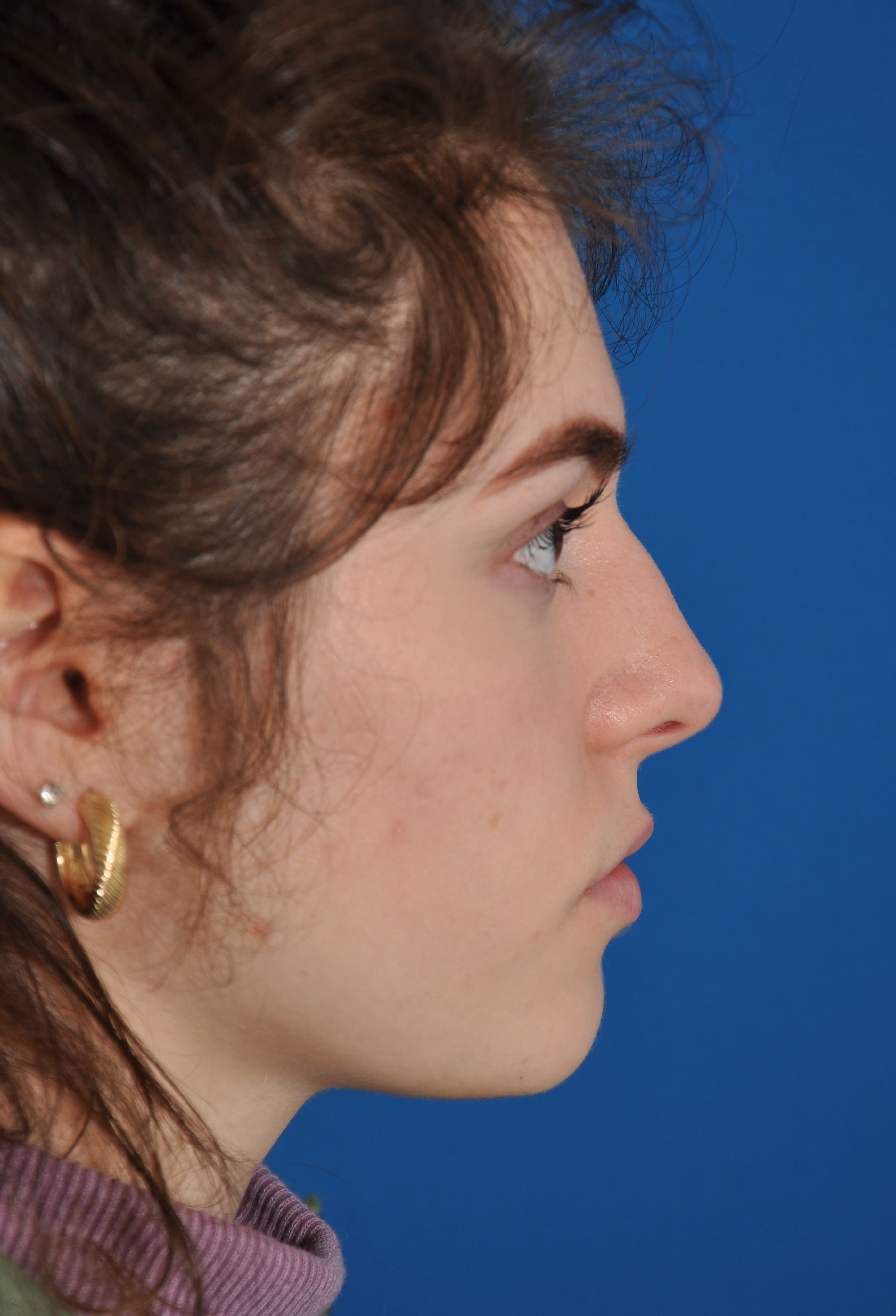 Rhinoplasty Before, undefined undefined - 1383