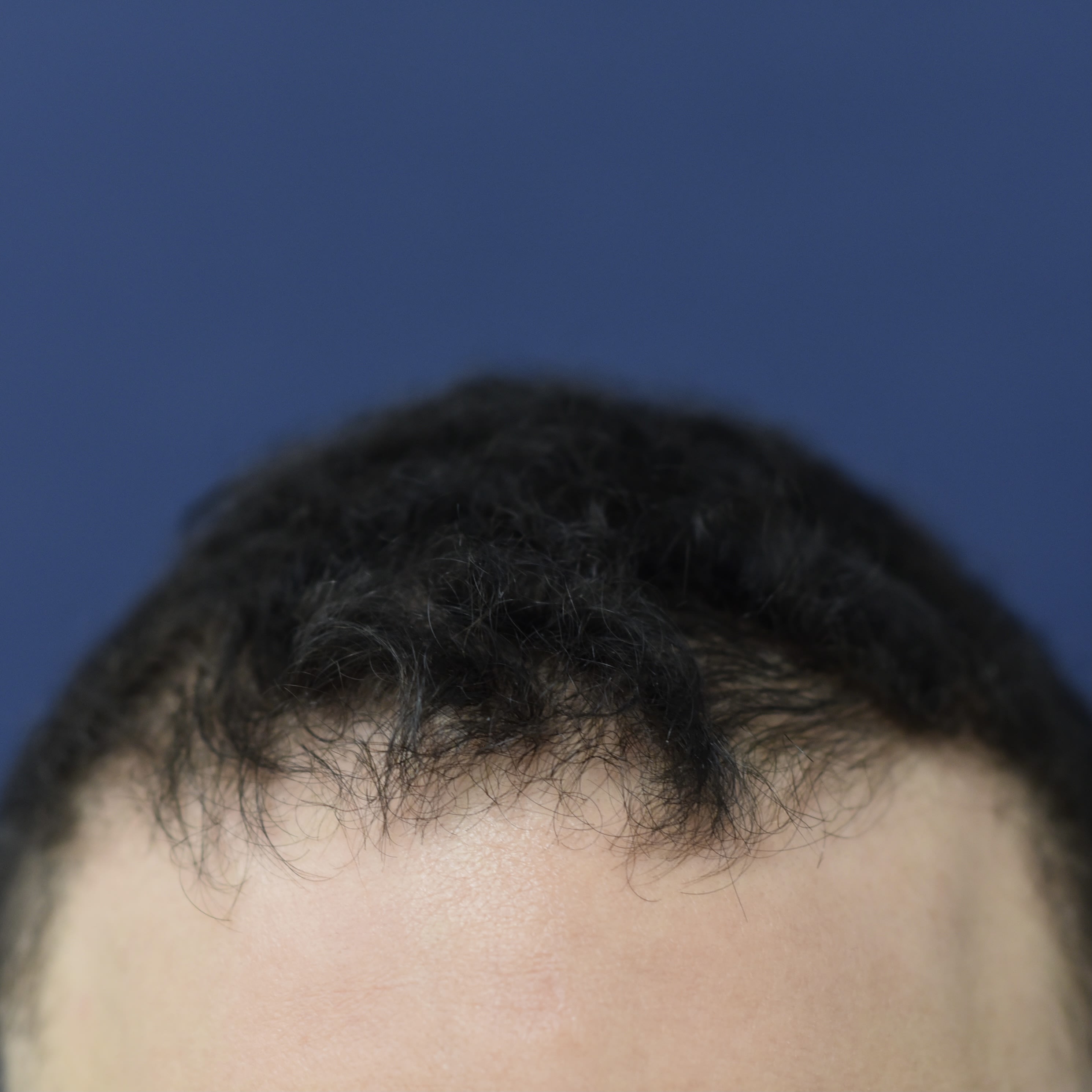 Hair Restoration Before, undefined undefined - 622